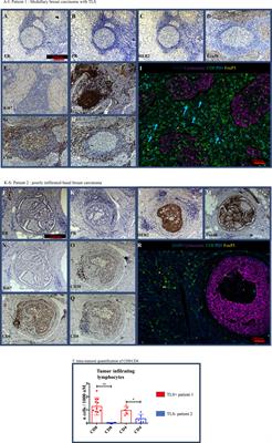 Cellular Composition and Contribution of Tertiary Lymphoid Structures to Tumor Immune Infiltration and Modulation by Radiation Therapy